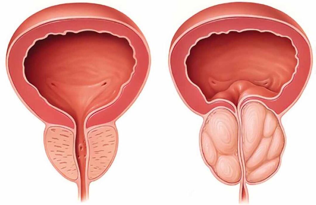 Prawidłowa prostata i zapalenie gruczołu krokowego (przewlekłe zapalenie gruczołu krokowego)