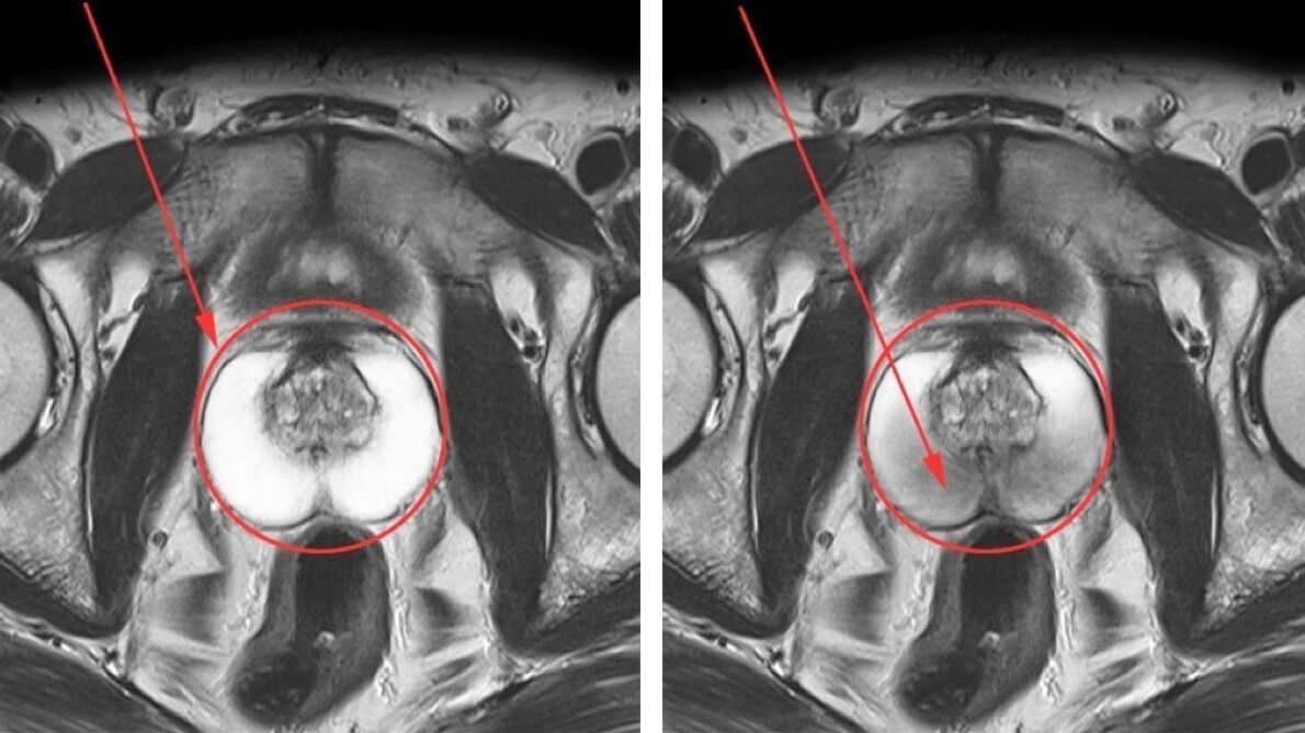 USG przewlekłego zapalenia gruczołu krokowego – prostata zdrowa (po lewej) i stan zapalny (po prawej)