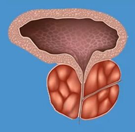 Charakterystyczne oznaki zapalenia prostaty