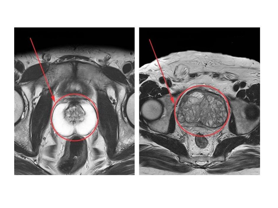 Porównanie zdrowej (po lewej) i stanu zapalnego (po prawej) prostaty na obrazach MRI