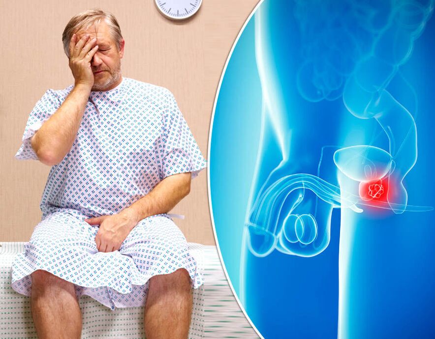 Mężczyzna z zapaleniem prostaty przechodzi diagnostykę choroby