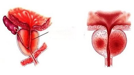 Jak wygląda przewlekłe zapalenie prostaty